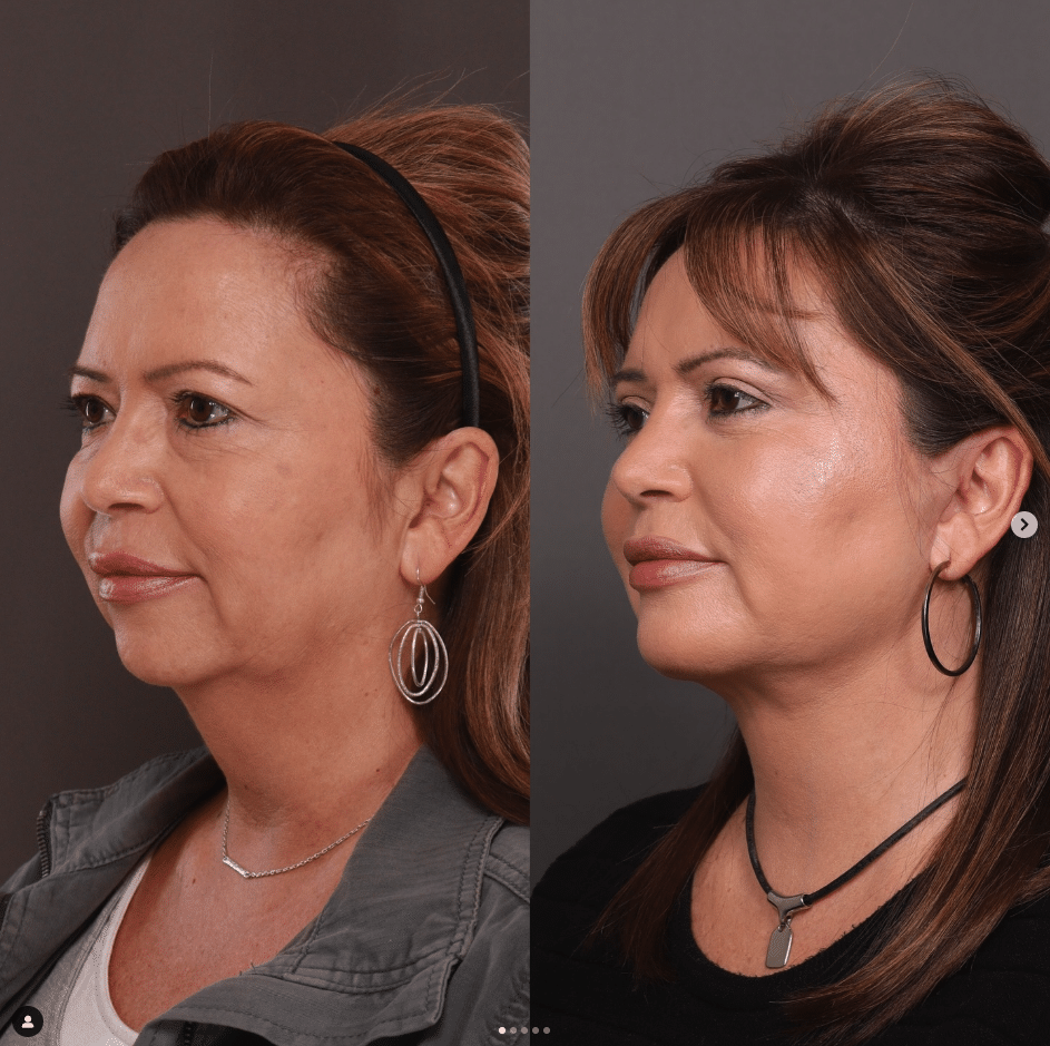 Utah Facial Plastics Facelift
